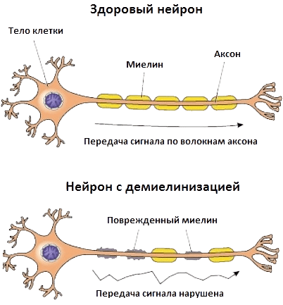 Здоровый и поврежденный нейроны