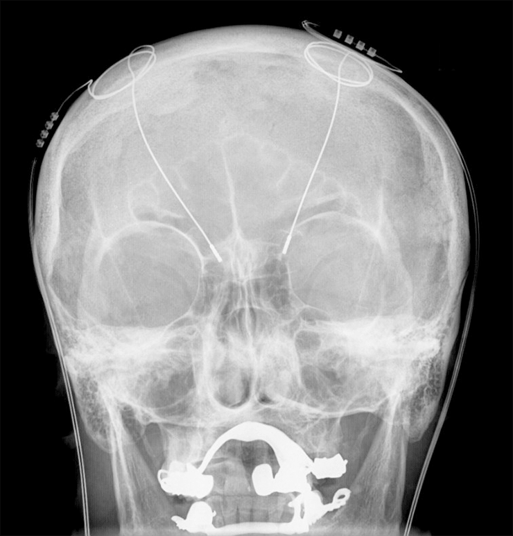 Рентгенограмма головы пациента