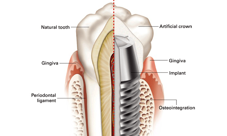 Строение зуба и имплантата