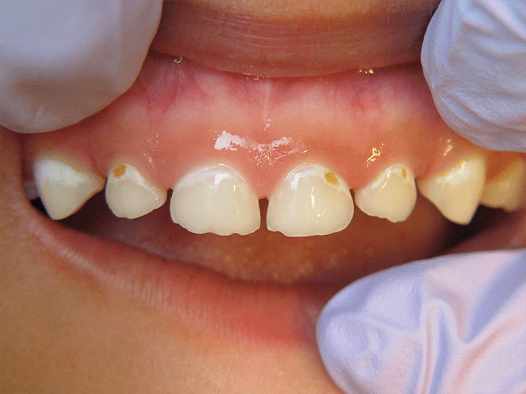 Повреждения зубной эмали у детей при кариесе