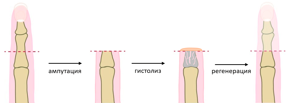 Гистолизу подвергается преимущественно костная ткань
