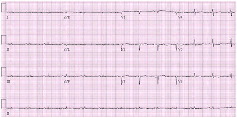 ЭКГ пациента с амилоидозом сердца с низкими амплитудами