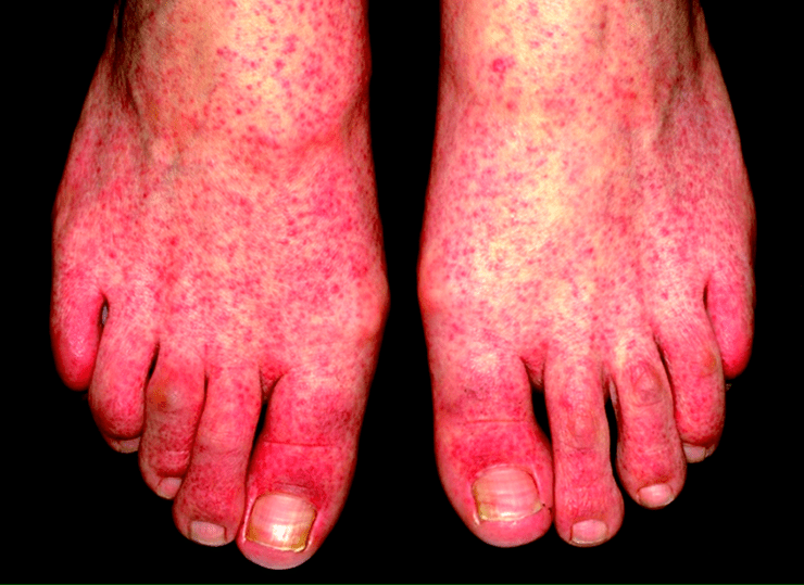 Синдром папуло-пурпурных перчаток и носков