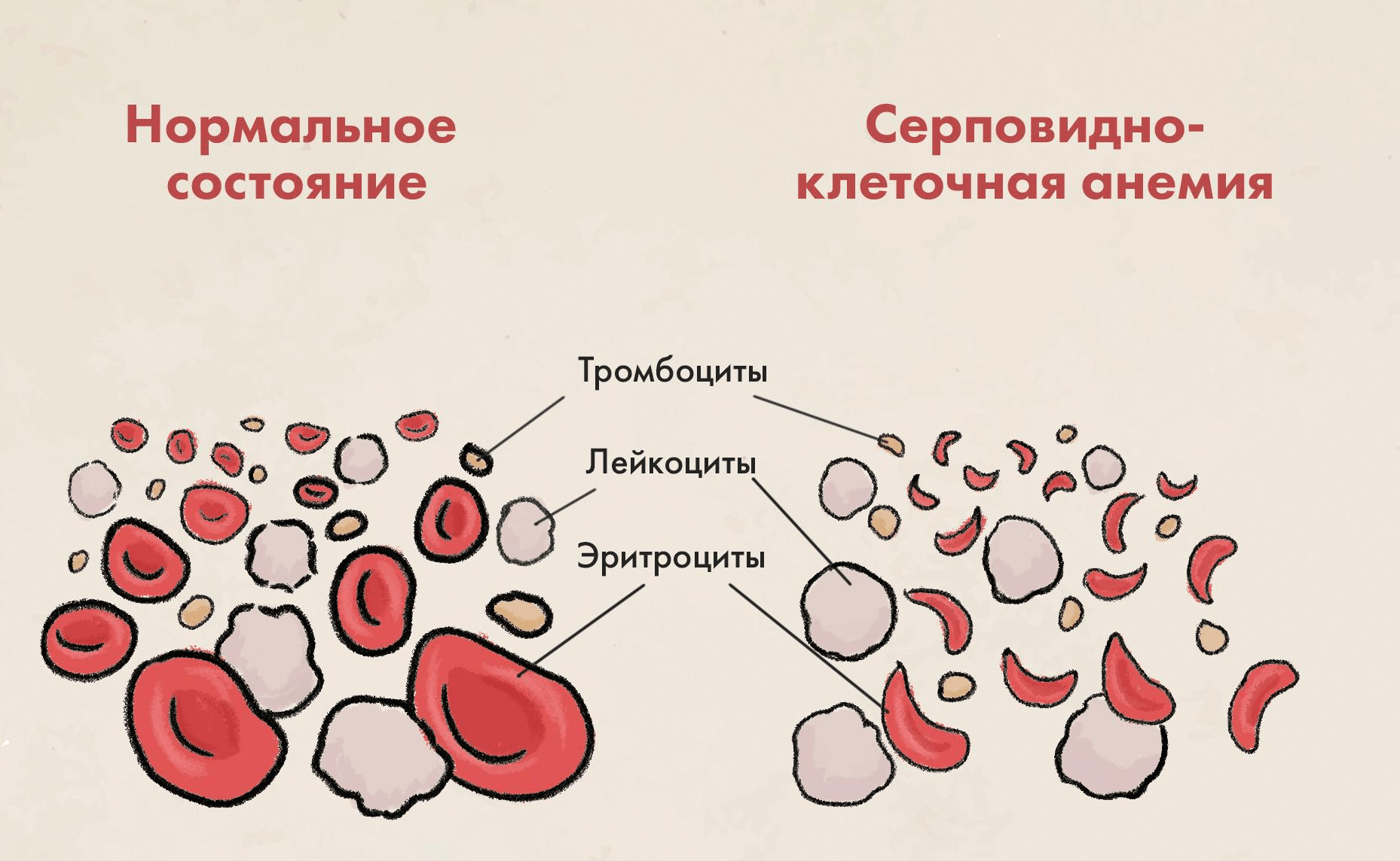 При серповидно-клеточной анемии эритроциты деформируются