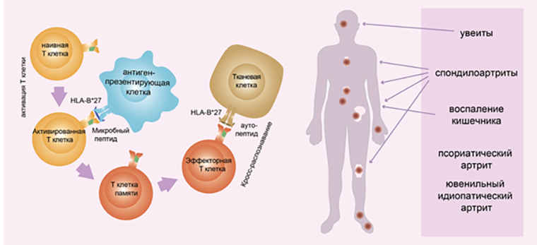 Предполагаемый механизм возникновения болезни Бехтерева и других HLA-B27 ассоциированных аутоиммунных заболеваний