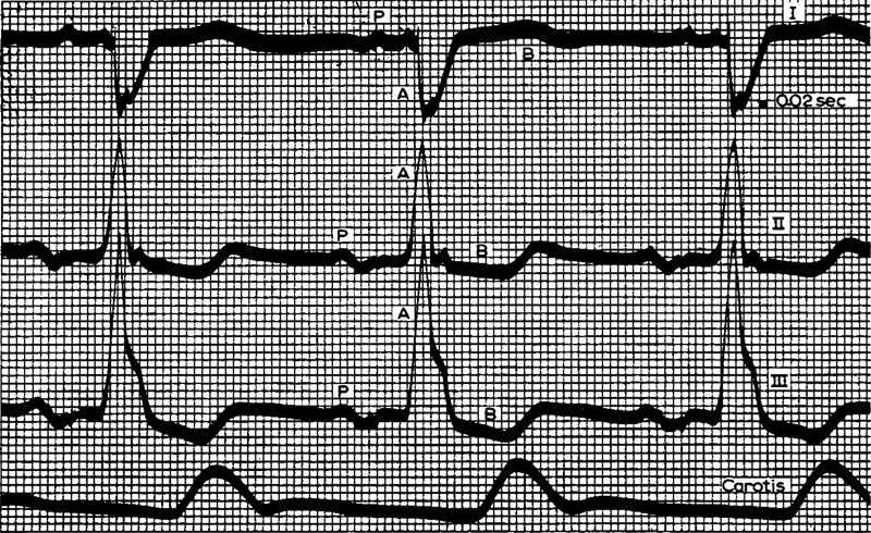 Подлинная кардиограмма, снятая Эйнтховеном