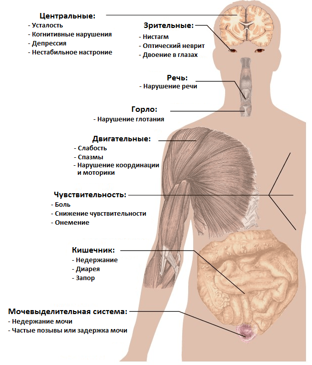 Основные симптомы рассеянного склероза