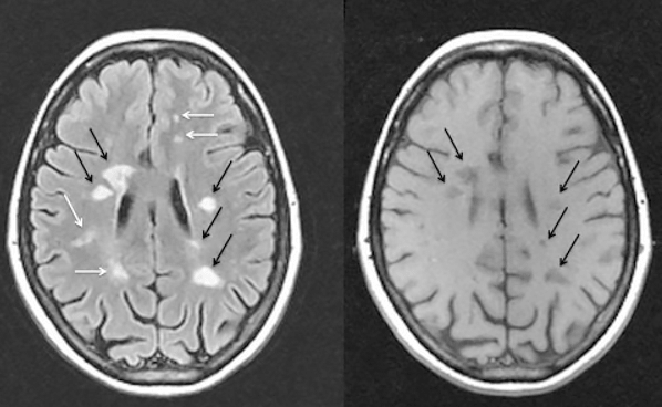 МРТ мозга пациента с РС