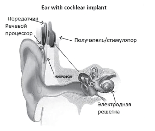 Ухо с кохлеарной имплантацией