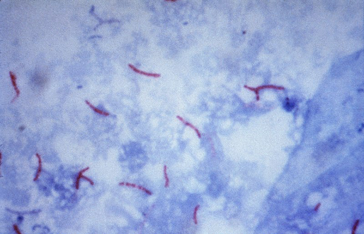 Микобактерии, окрашенные методом Циля-Нильсена