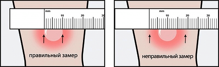 Правильная и неправильная оценки диаметра папулы