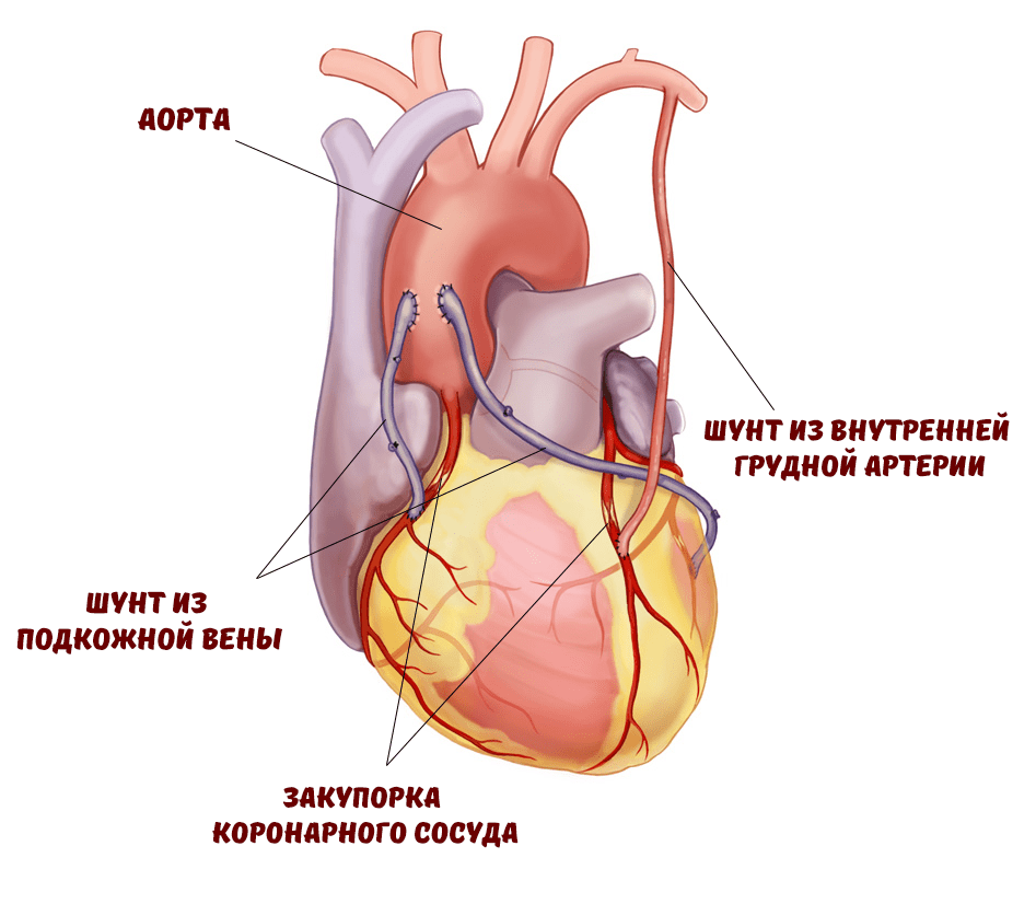 Сердце после операции коронарного шунтирования