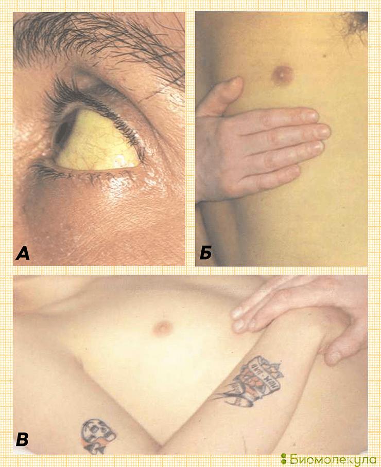 Пожелтение склер и кожи во время гепатита В