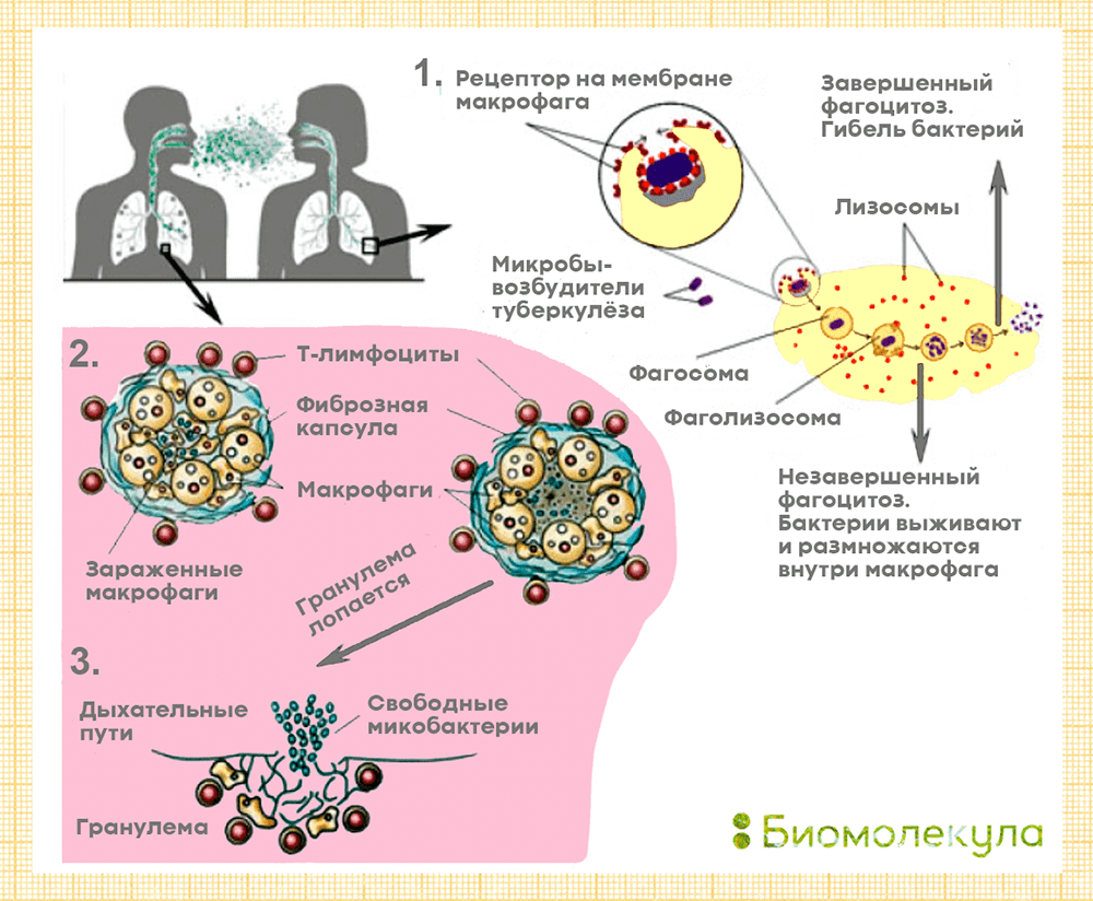 Схема патогенеза туберкулеза легких