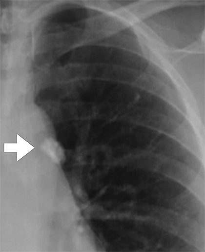 Гранулема на рентгеновском снимке грудной клетки
