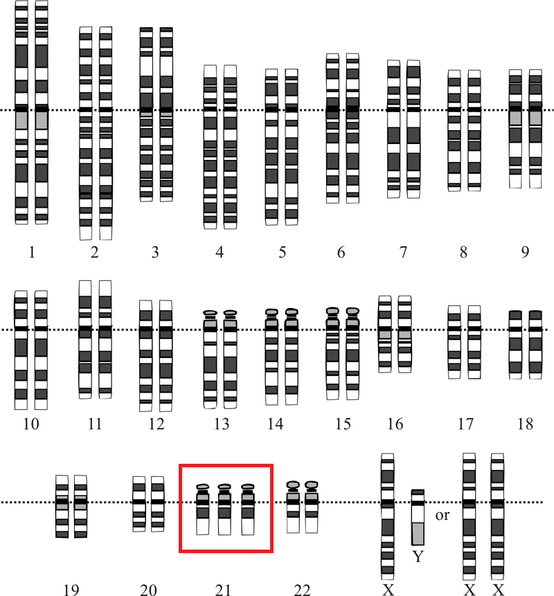 Хромосомный набор человека с синдромом Дауна