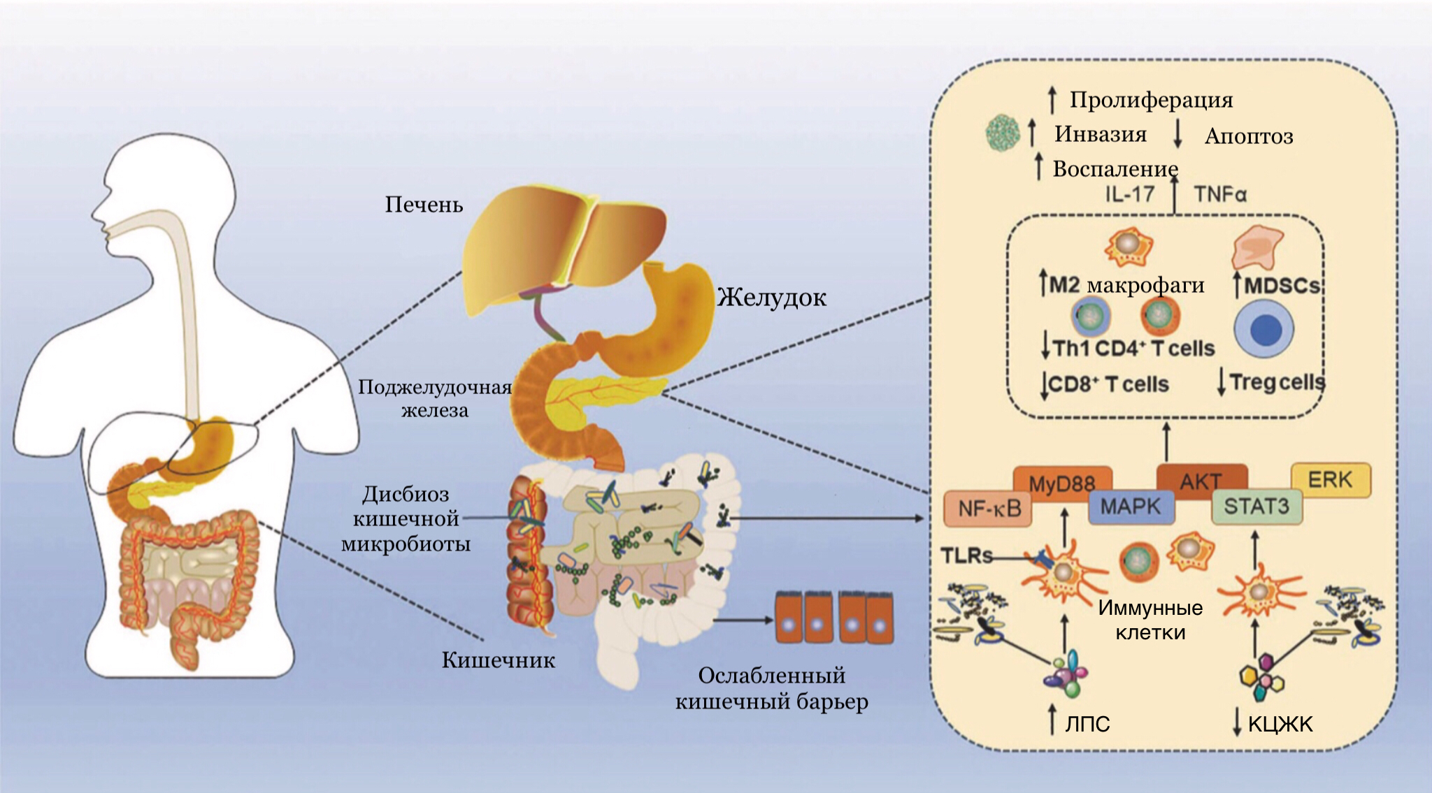 Предполагаемая связь между дисбактериозом кишечной микробиоты и раком поджелудочной железы