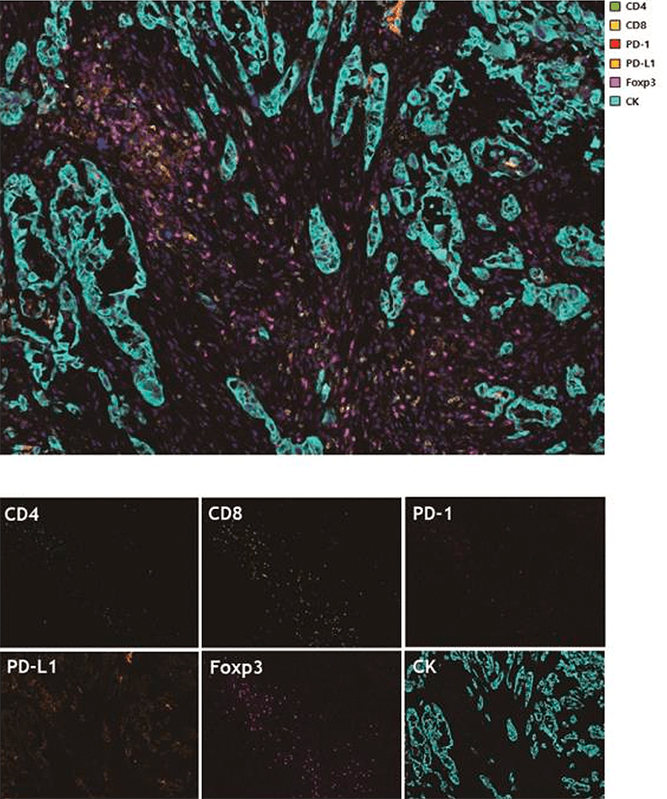Картина мультиспектрального окрашивания иммунных клеток в опухолевой ткани щитовидной железы при помощи TSA