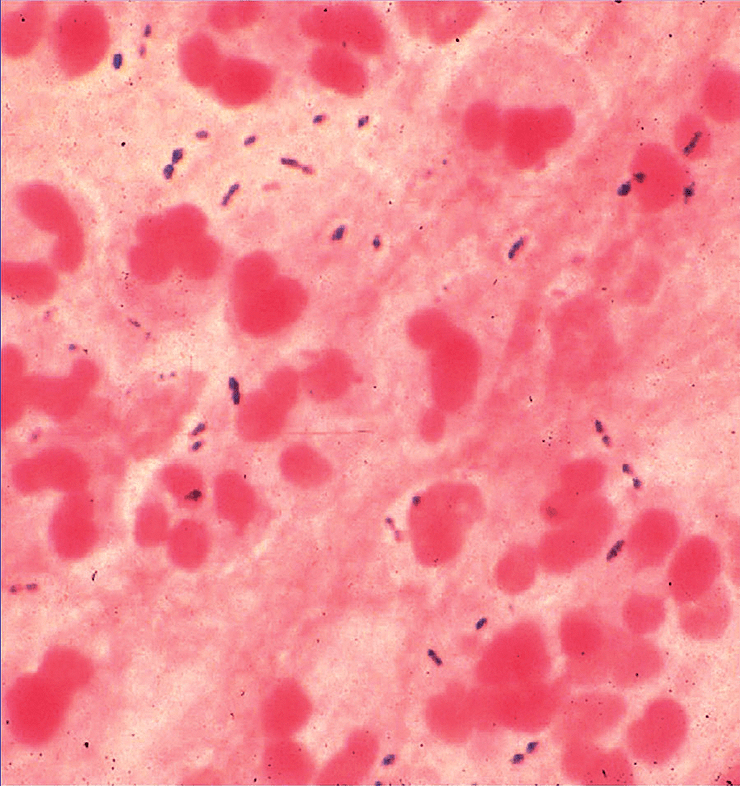 Образец мокроты больного с установленной пневмококковой инфекцией