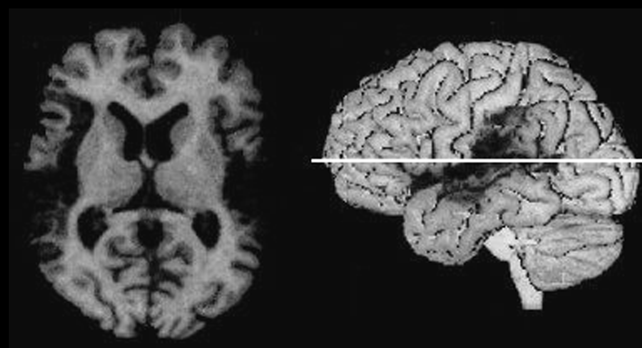 Пример МРТ-снимка, позволяющего выявить повреждение мозга