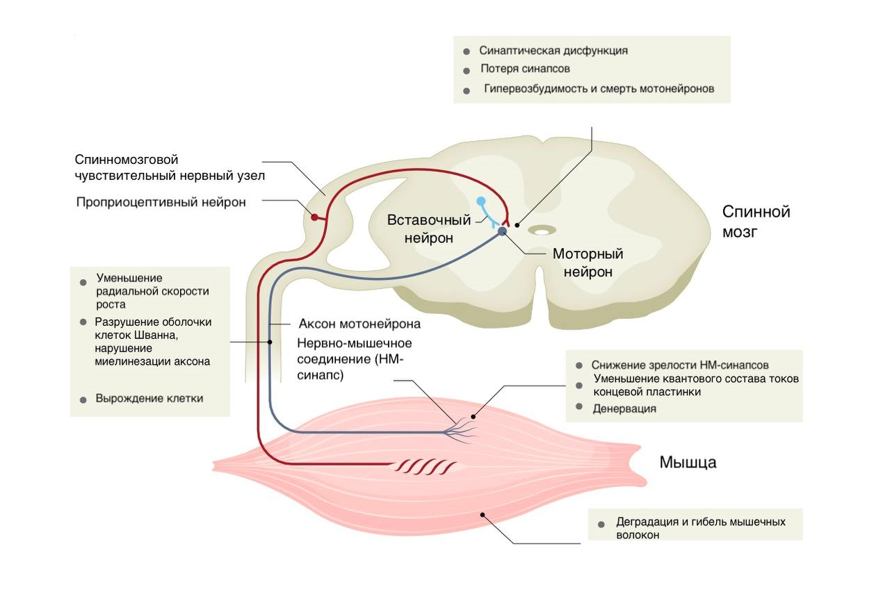 При развитии СМА страдают двигательные нейроны, нервно-мышечные соединения и мышцы