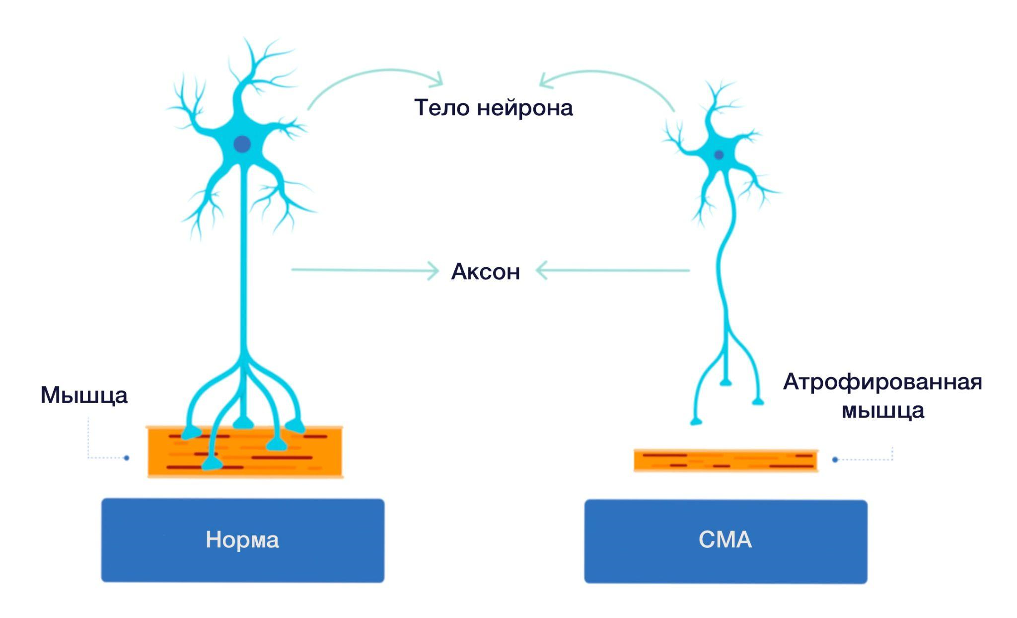 При развитии СМА страдают двигательные нейроны, нервно-мышечные соединения и мышцы