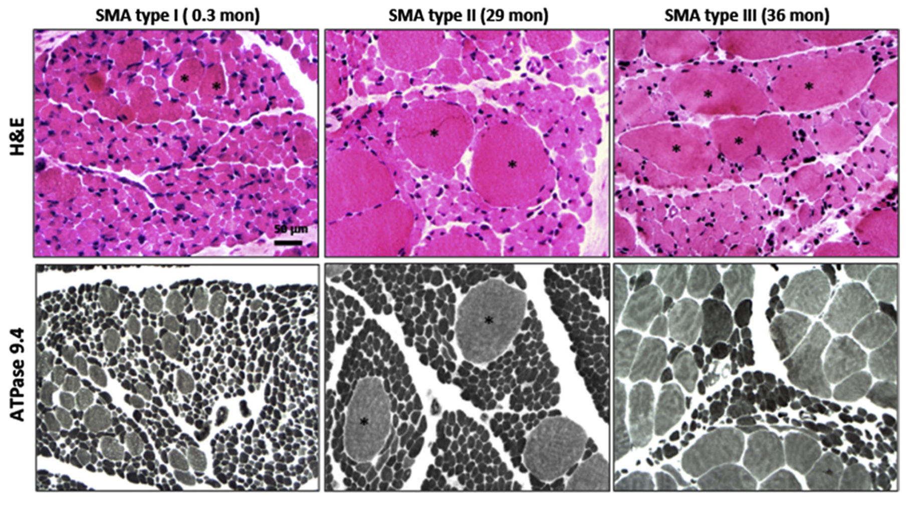 Результаты мышечной биопсии при СМА 1–3 типов