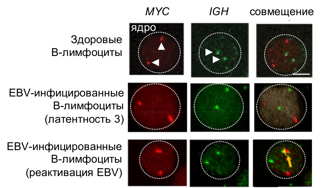 Расположение участков MYC (красный) и IGH (тяжелая цепь иммуноглобулинов, зеленый) в ядре В-лимфоцитов