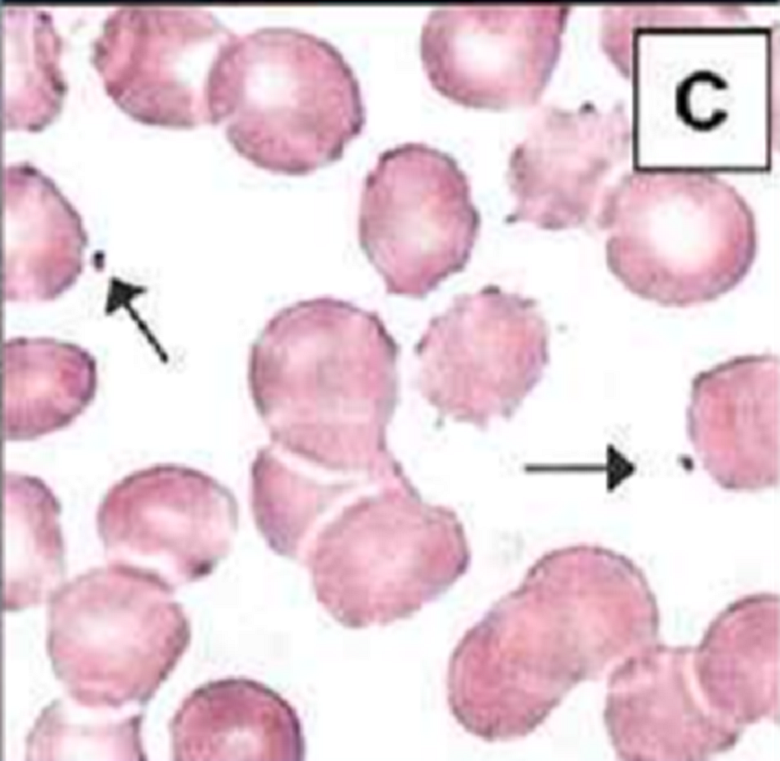 Клетки при синдроме Вискотта-Олдрича, аномальные обозначены стрелками