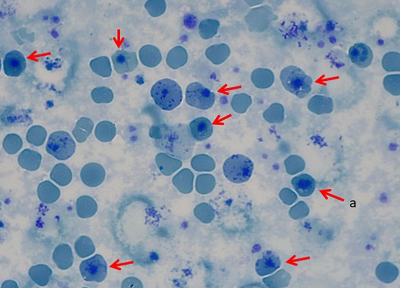 Клетки больного β-талассемией (обозначены стрелочками)