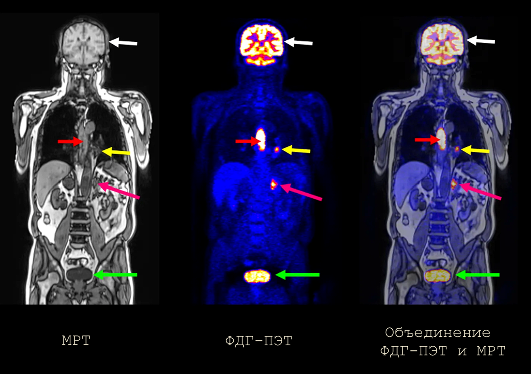 Разные методы визуализации по-разному и с разной точностью видят опухоли