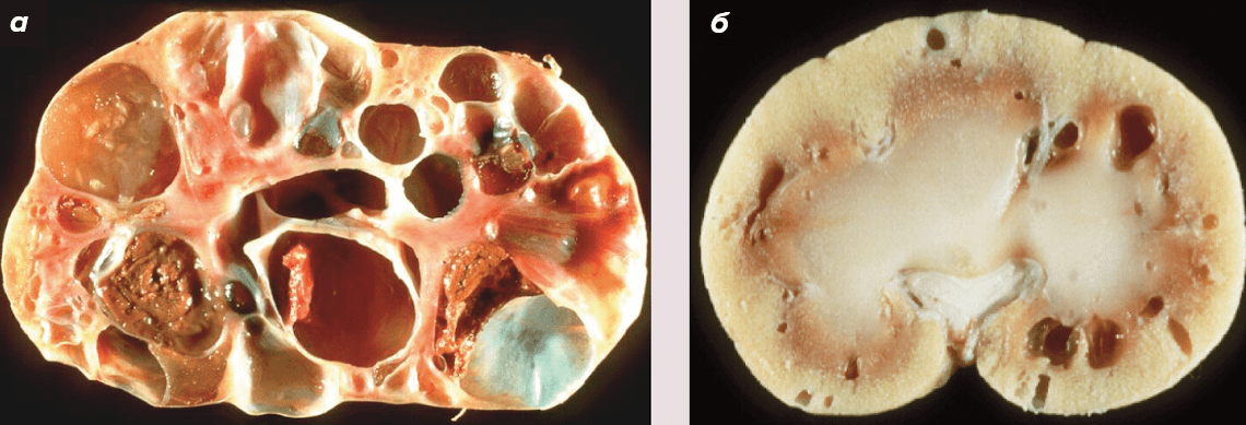 Тяжелая (а) и легкая (б) форма поликистоза почек