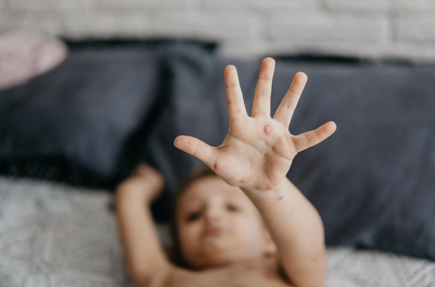 Типичные для ветрянки высыпания в виде мелких пузырьков