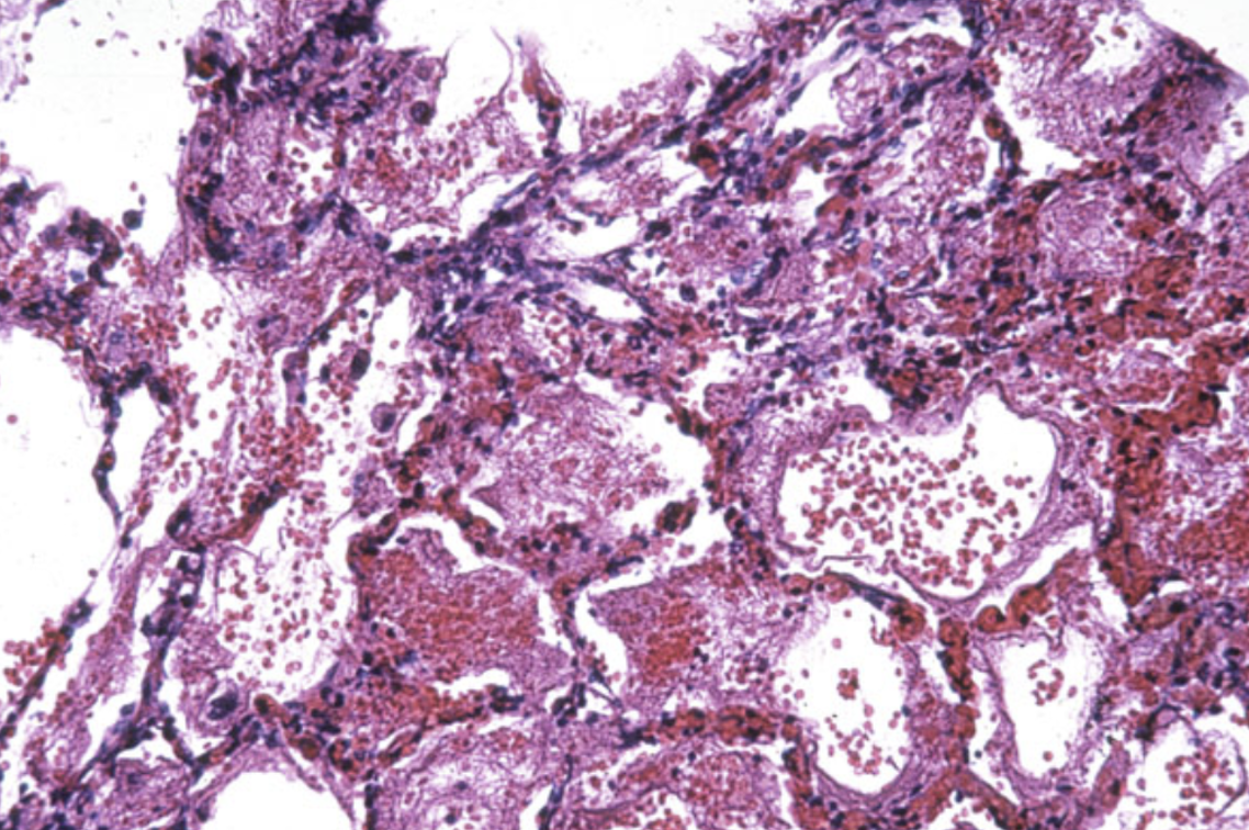 Кровоизлияние в альвеолах