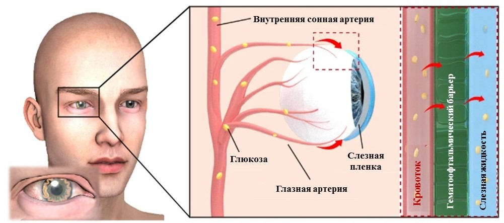 Схематическое изображение утечки плазмы в человеческом глазу Схематическое изображение утечки плазмы в человеческом глазу
