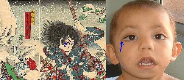 Изображение сцены из японской драмы кабуки и фотография мальчика с синдромом Кабуки