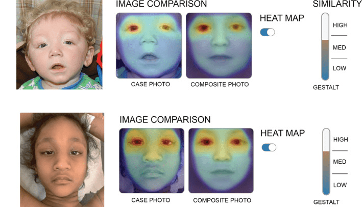 Анализ фотографий пациентов в программе Face2Gene