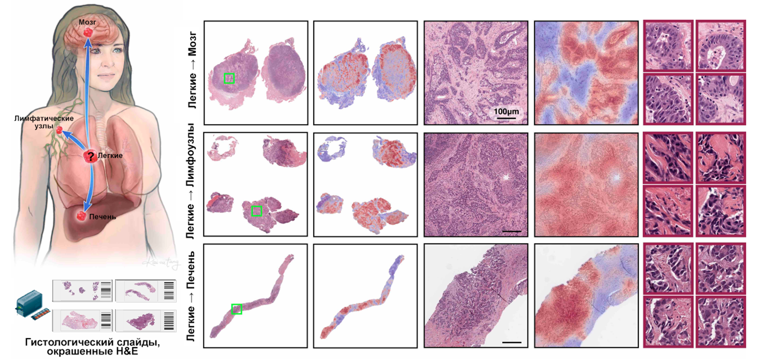 TOAD выделяет наиболее важные участки метастазов и определяет первичный очаг