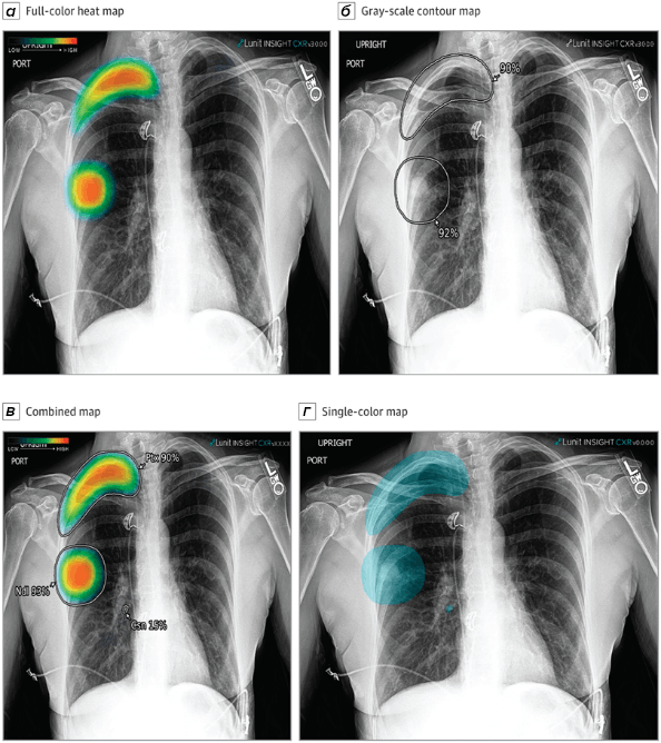 ИИ в медицинской визуализации: робот анализирует рентгеновский снимок легких