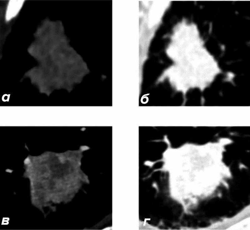 На практике радиомические модели работают с точностью выше 80–90% и могут решать задачи предсказания эффективности лечения