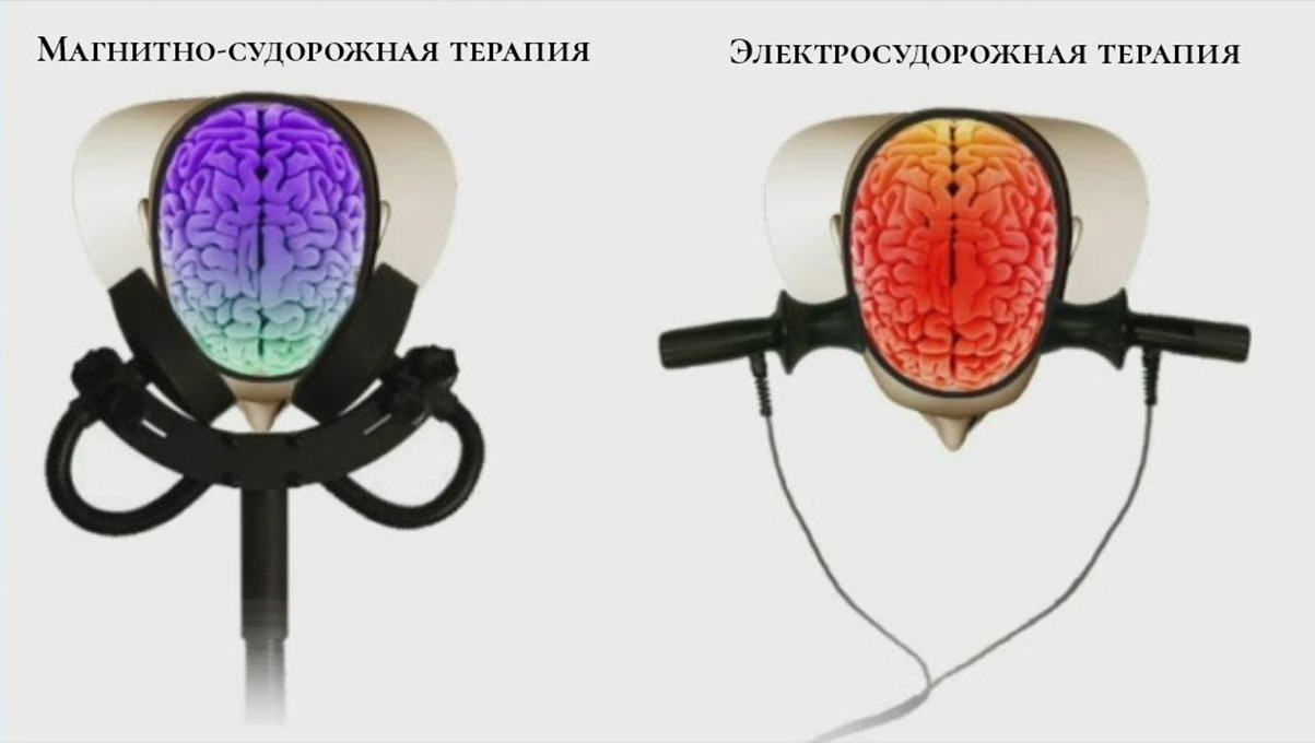 МСТ похожа на ЭСТ тем, что вызывает судорожные приступы