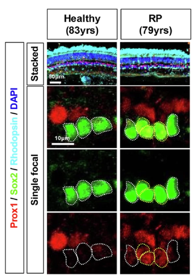 Распределение белка Prox1 в сетчатке человека