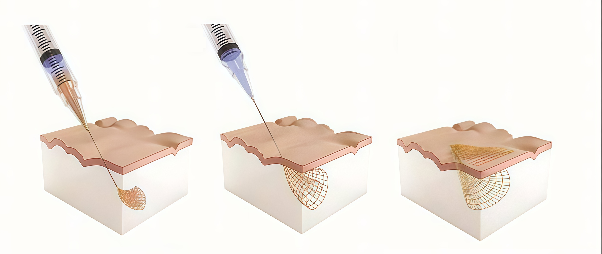 Схема и принцип инъекции сетчатых электродов