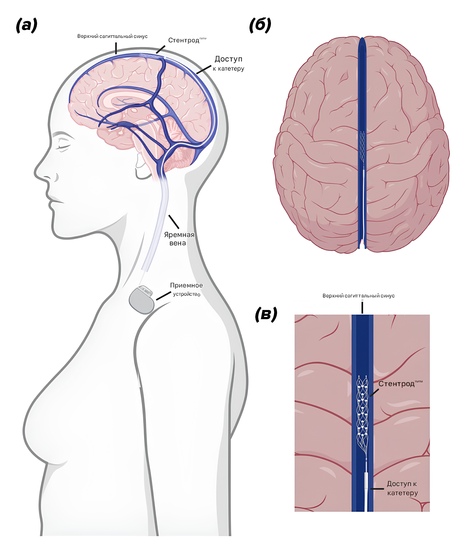 Имплантация Stentrode™
