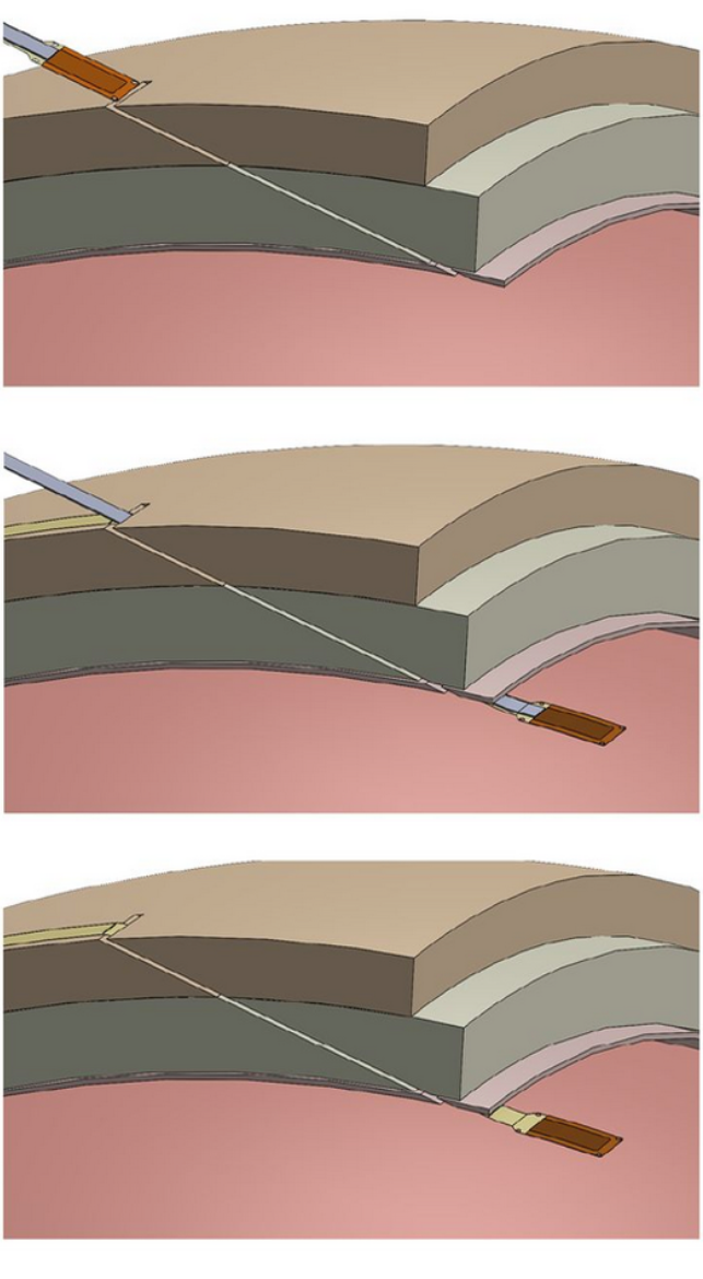 Техника введения «краниальной микрощели»