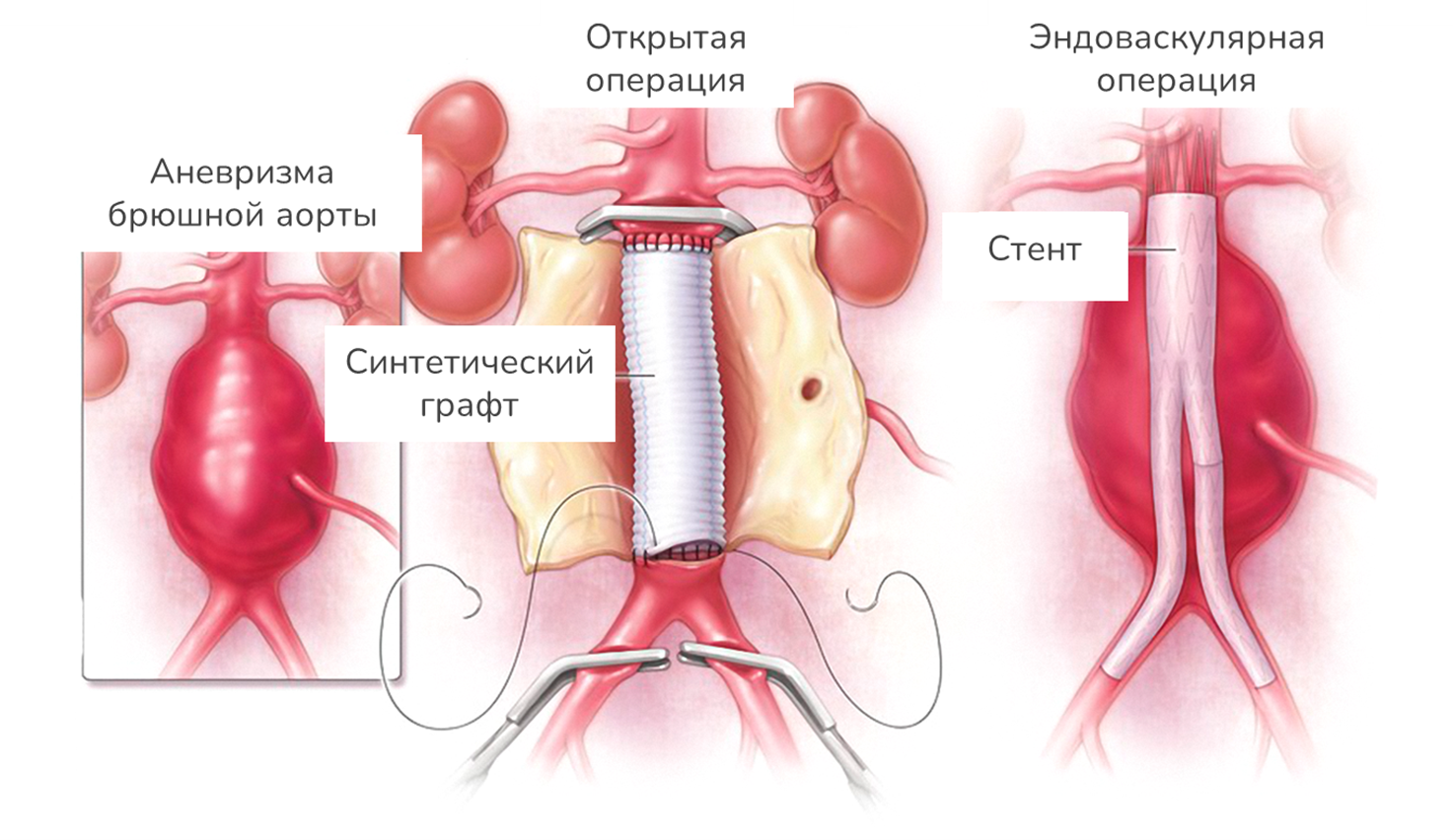 Два способа операций на АБА