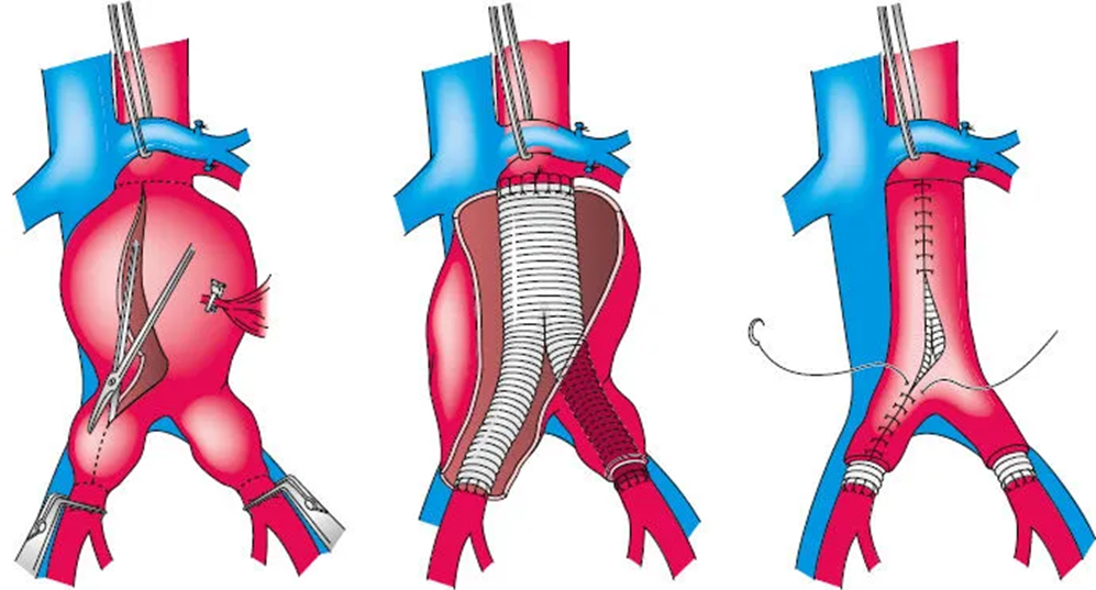 Открытая операция на АБА