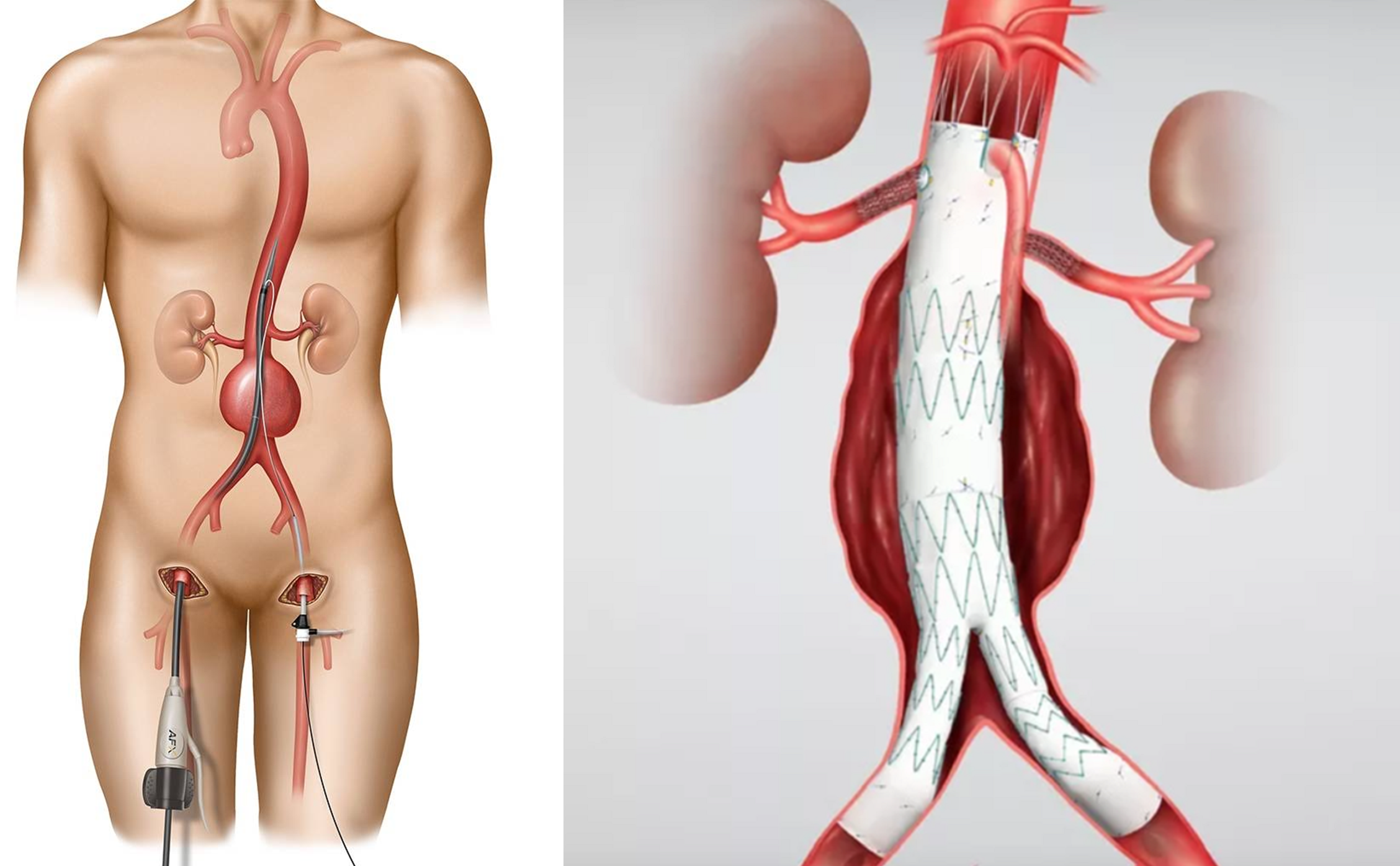 Доступ в эндоваскулярной операции и установленный стент-графт в просвете аневризмы