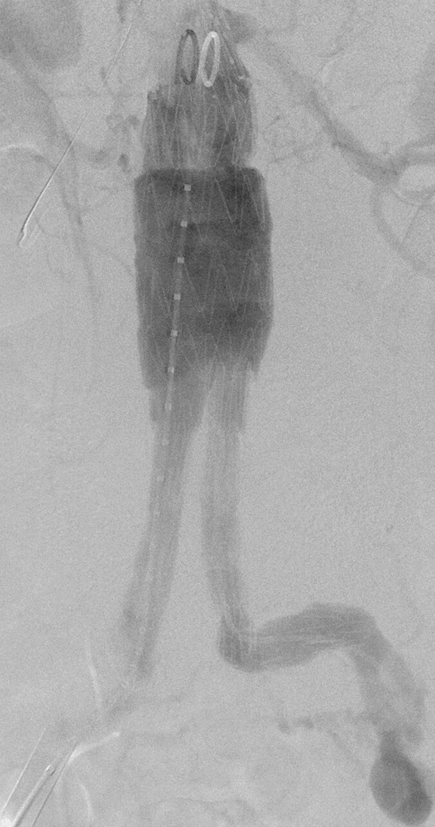 Рисунок 6Б. Ангиограмма после эндоваскулярной пластики аневризмы и установки стент-графта