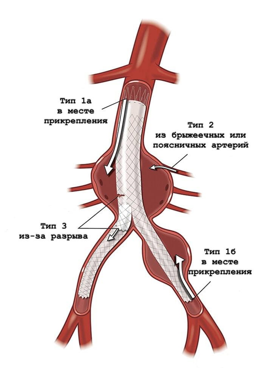 Иллюстрация эндоликов типов I, II и III